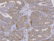 IHC staining of FFPE human endometrial adenocarcinoma tissue with BI-1 antibody. HIER: boil tissue sections in pH8 EDTA for 20 min and allow to cool before testing.