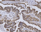 IHC staining of FFPE human lung squamous cell carcinoma tissue with HO-2 antibody. HIER: boil tissue sections in pH8 EDTA for 20 min and allow to cool before testing.
