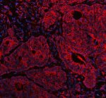 INF2 Antibody Human Intestine Cancer IF. Immunofluorescent staining of FFPE human intestine cancer tissue with INF2 Antibody at 5 ug/ml. HIER was performed using pH 8 EDTA buffer, followed by blocking with 10% goat serum. The tissue section was incubated with rabbit anti-INF2 antibody overnight at 4Â°C, followed by Cy3 conjugated goat anti-rabbit IgG secondary antibody (red). Nuclei were counterstained with DAPI (blue). INF2 Antibody / Actin Regulation Protein Antibody demonstrates cytoplasmic staining consistent with Inverted Formin 2 expression and supports studies of actin cytoskeleton remodeling, intracellular organization and cell structure regulation pathways.