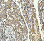 INF2 Antibody Human Colon Cancer IHC. Immunohistochemistry staining of FFPE human colon cancer tissue with INF2 Antibody at 2 ug/ml. HIER was performed using pH 8 EDTA buffer, followed by blocking with 10% goat serum. The tissue section was incubated with rabbit anti-INF2 antibody overnight at 4Â°C, followed by HRP-conjugated goat anti-rabbit IgG secondary antibody and DAB chromogen detection. INF2 Antibody / Actin Regulation Protein Antibody demonstrates cytoplasmic staining consistent with Inverted Formin 2 expression and supports studies of actin cytoskeleton remodeling, intracellular organization and cell structure regulation pathways.