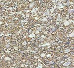INF2 Antibody Human Thyroid Cancer IHC. Immunohistochemistry staining of FFPE human thyroid cancer tissue with INF2 Antibody at 2 ug/ml. HIER was performed using pH 8 EDTA buffer, followed by blocking with 10% goat serum. The tissue section was incubated with rabbit anti-INF2 antibody overnight at 4Â°C, followed by HRP-conjugated goat anti-rabbit IgG secondary antibody and DAB chromogen detection. INF2 Antibody / Actin Regulation Protein Antibody demonstrates cytoplasmic staining consistent with Inverted Formin 2 expression and supports studies of actin cytoskeleton remodeling, intracellular organization and cell structure regulation pathways.
