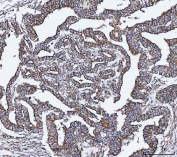VAPA Antibody Cervical Cancer IHC. Immunohistochemistry staining of FFPE human cervical cancer tissue using VAPA Antibody / ER Membrane Contact Site Protein demonstrates moderate to strong HRP-DAB brown staining throughout malignant epithelial cell populations. The observed staining pattern is predominantly membranous and cytoplasmic, consistent with expression of Vesicle-Associated Membrane Protein-Associated Protein A (VAPA), an endoplasmic reticulum-associated protein involved in membrane contact site formation, intracellular trafficking, and organelle communication. Staining highlights tumor-associated epithelial structures and supports evaluation of VAPA expression and localization in human cervical cancer tissue. Heat-induced epitope retrieval was performed by boiling tissue sections in pH 8 EDTA buffer for 20 minutes followed by cooling prior to staining.