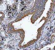 VAPA Antibody Lung Adenocarcinoma IHC. Immunohistochemistry staining of FFPE human lung adenocarcinoma tissue using VAPA Antibody / ER Membrane Contact Site Protein demonstrates strong HRP-DAB brown staining within malignant glandular epithelial cells. The observed staining pattern is predominantly membranous and cytoplasmic, consistent with expression of Vesicle-Associated Membrane Protein-Associated Protein A (VAPA), an endoplasmic reticulum-associated protein involved in membrane contact site formation, intracellular trafficking, lipid transport, and organelle communication. Staining prominently outlines neoplastic glandular structures and supports evaluation of VAPA expression and localization in human lung adenocarcinoma tissue. Heat-induced epitope retrieval was performed by boiling tissue sections in pH 8 EDTA buffer for 20 minutes followed by cooling prior to staining.