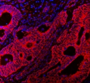 VAPA Antibody Colorectal Adenocarcinoma IF. Immunofluorescence staining of FFPE human colorectal adenocarcinoma tissue using VAPA Antibody / ER Membrane Contact Site Protein demonstrates strong red fluorescence throughout malignant glandular epithelial cell populations. The observed staining pattern is predominantly cytoplasmic with associated membranous localization, consistent with expression of Vesicle-Associated Membrane Protein-Associated Protein A (VAPA), an endoplasmic reticulum-associated protein involved in membrane contact site formation, intracellular trafficking, lipid transport, and organelle communication. Signal highlights neoplastic glandular structures within the tumor tissue, while nuclei are counterstained with DAPI (blue). Heat-induced epitope retrieval was performed by steaming tissue sections in pH 8 EDTA buffer for 20 minutes prior to staining. Target protein is visualized in red and nuclei are shown in blue.