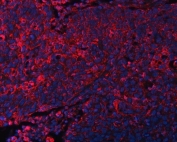 DOCK1 Antibody Esophageal Squamous Cell Carcinoma IF. Immunofluorescent staining of FFPE human esophageal squamous cell carcinoma tissue using DOCK1 Antibody / Cell Migration Protein Antibody demonstrates widespread cytoplasmic and membranous staining (red) throughout malignant epithelial cell populations, consistent with expression of Dedicator of Cytokinesis 1 (DOCK1). DOCK1 is a Rac guanine nucleotide exchange factor that regulates cell migration, cytoskeletal remodeling, and cellular adhesion through activation of Rac-dependent signaling pathways. The observed staining pattern is consistent with the established role of DOCK1 in coordinating dynamic cellular behavior and tissue organization. DAPI nuclear stain (blue) identifies cell nuclei and provides contrast to the predominantly cytoplasmic distribution of DOCK1. HIER: boil tissue sections in pH8 EDTA for 20 min and allow to cool before testing.