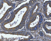 DOCK1 Antibody Human Colorectal Adenocarcinoma IHC. Immunohistochemistry staining of FFPE human colorectal adenocarcinoma tissue using DOCK1 Antibody / Cell Migration Protein Antibody demonstrates strong cytoplasmic and membranous staining within malignant gland-forming epithelial cells, consistent with expression of Dedicator of Cytokinesis 1 (DOCK1). DOCK1 is a Rac guanine nucleotide exchange factor that regulates cell migration, cytoskeletal remodeling, cellular adhesion, and tissue organization through activation of Rac-dependent signaling pathways. The observed staining pattern is consistent with the established role of DOCK1 in coordinating dynamic cellular behavior and interactions with the surrounding microenvironment. These findings support the utility of DOCK1 antibody for studies of cell migration, cytoskeletal regulation, and signaling pathways involved in tissue architecture and cellular motility. HIER: boil tissue sections in pH8 EDTA for 20 min and allow to cool before testing.