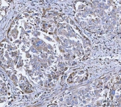 DOCK1 Antibody Human Lung Adenocarcinoma IHC. Immunohistochemistry staining of FFPE human lung adenocarcinoma tissue using DOCK1 Antibody / Cell Migration Protein Antibody demonstrates moderate cytoplasmic staining within malignant epithelial cell populations, consistent with expression of Dedicator of Cytokinesis 1 (DOCK1). DOCK1 is a Rac guanine nucleotide exchange factor that regulates cell migration, cytoskeletal remodeling, cellular adhesion, and tissue organization through activation of Rac-dependent signaling pathways. The observed staining pattern is consistent with the established role of DOCK1 in coordinating dynamic cellular behavior and communication with the surrounding tissue microenvironment. These findings support the utility of DOCK1 antibody for studies of cell migration, cytoskeletal regulation, and signaling pathways involved in tissue architecture and cellular motility. HIER: boil tissue sections in pH8 EDTA for 20 min and allow to cool before testing.