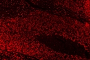 Immunofluorescent staining of FFPE human esophageal squamous carcinoma tissue with SAE1 antibody. HIER: steam section in pH8 EDTA buffer for 20 min.