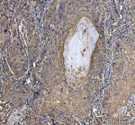 Hsp90 beta Antibody Human Laryngeal Squamous Cell Carcinoma IHC. Immunohistochemistry analysis of FFPE human laryngeal squamous cell carcinoma tissue using Hsp90 beta Antibody. Heat induced antigen retrieval was performed in pH 8.0 EDTA buffer prior to overnight incubation with primary antibody (2 ug/mL) at 4Â°C. Peroxidase-conjugated goat anti-mouse IgG and DAB chromogen were used for visualization. Strong predominantly cytoplasmic staining is observed in malignant squamous epithelial cells, consistent with the intracellular localization of HSP90AB1 as a constitutively expressed molecular chaperone. These results support the use of Hsp90 beta Antibody for studying HSP90AB1, molecular chaperone function and cancer-associated protein homeostasis.