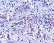 Desmoglein 2 Antibody Breast Cancer IHC. Immunohistochemistry analysis of FFPE human breast cancer tissue stained with DSG2 antibody detecting Desmoglein 2. Tumor epithelial cells show membranous and cytoplasmic staining with focal accentuation at cell-cell borders, consistent with DSG2 localization in desmosomal adhesion complexes that maintain epithelial cohesion. Surrounding stromal elements display minimal staining. Hematoxylin counterstain highlights nuclei in blue. HIER: boil tissue sections in pH 8 EDTA for 20 min and allow to cool before testing.