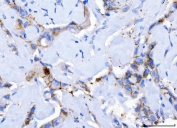 Desmoglein 2 Antibody Breast Cancer IHC. Immunohistochemistry analysis of FFPE human breast cancer tissue stained with DSG2 antibody detecting Desmoglein 2. Tumor epithelial cells show moderate membranous and cytoplasmic staining with focal junctional accentuation at cell-cell borders, consistent with DSG2 localization in desmosomal adhesion complexes that contribute to epithelial cohesion. Staining is heterogeneous across tumor regions, while surrounding stromal components display minimal signal. Hematoxylin counterstain highlights nuclei in blue. HIER: boil tissue sections in pH 8 EDTA for 20 min and allow to cool before testing.