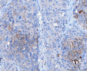 Desmoglein 2 Antibody Hepatocellular Carcinoma IHC. Immunohistochemistry analysis of FFPE human hepatocellular carcinoma tissue stained with DSG2 antibody detecting Desmoglein 2. Tumor cells show membranous and cytoplasmic staining with focal accentuation at cell-cell borders, consistent with DSG2 localization in desmosomal adhesion complexes that support intercellular adhesion. Staining appears heterogeneous across tumor regions, while adjacent non-tumor areas show reduced signal. Hematoxylin counterstain highlights nuclei in blue. HIER: boil tissue sections in pH 8 EDTA for 20 min and allow to cool before testing.