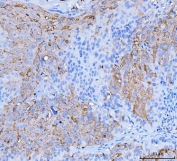 Desmoglein 2 Antibody Laryngeal Squamous Cell Carcinoma IHC. Immunohistochemistry analysis of FFPE human laryngeal squamous cell carcinoma tissue stained with DSG2 antibody detecting Desmoglein 2. Tumor epithelial cells show membranous and cytoplasmic staining with prominent accentuation at cell-cell borders, consistent with DSG2 localization in desmosomal adhesion complexes that maintain epithelial cohesion. The staining highlights squamous tumor cell clusters, while surrounding stromal regions show reduced signal. Hematoxylin counterstain highlights nuclei in blue. HIER: boil tissue sections in pH 8 EDTA for 20 min and allow to cool before testing.