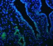 SLC22A8 / OAT3 Antibody Prostate Cancer IF. Immunofluorescence staining of FFPE human prostate cancer tissue using SLC22A8 Antibody / Organic Anion Transporter 3 (OAT3) Antibody demonstrates distinct green fluorescence within subsets of epithelial tumor-associated cells, consistent with expression of the membrane transporter SLC22A8/OAT3. Signal is observed in discrete cellular populations against a background of DAPI-counterstained nuclei (blue), supporting evaluation of transporter expression and localization in human prostate cancer tissue. Heat-induced epitope retrieval was performed by steaming tissue sections in pH 8 EDTA buffer for 20 minutes prior to staining. Target protein is visualized in green and nuclei are shown in blue.