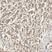 SLC22A8 / OAT3 Antibody Breast Cancer IHC. Immunohistochemistry staining of FFPE human breast cancer tissue using SLC22A8 Antibody / Organic Anion Transporter 3 (OAT3) Antibody demonstrates moderate to strong HRP-DAB brown staining within malignant epithelial cell populations. The observed staining pattern is predominantly membranous and cytoplasmic, consistent with expression of SLC22A8/OAT3, a transmembrane organic anion transporter involved in cellular uptake and transport of endogenous metabolites and xenobiotic compounds. These results support evaluation of OAT3 expression and localization in human breast cancer tissue. Heat-induced epitope retrieval was performed by boiling tissue sections in pH 8 EDTA buffer for 20 minutes followed by cooling prior to staining.