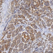 SLC22A8 / OAT3 Antibody Prostate Adenocarcinoma IHC. Immunohistochemistry staining of FFPE human prostate adenocarcinoma tissue using SLC22A8 Antibody / Organic Anion Transporter 3 (OAT3) Antibody demonstrates moderate to strong HRP-DAB brown staining within malignant glandular epithelial cells. The observed staining pattern is predominantly membranous and cytoplasmic, consistent with expression of SLC22A8/OAT3, a transmembrane transporter involved in organic anion uptake and cellular transport of endogenous metabolites and xenobiotic compounds. Staining highlights neoplastic glandular structures within the tumor microenvironment and supports evaluation of OAT3 expression and localization in human prostate adenocarcinoma tissue. Heat-induced epitope retrieval was performed by boiling tissue sections in pH 8 EDTA buffer for 20 minutes followed by cooling prior to staining.