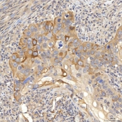 SLC22A8 / OAT3 Antibody Larynx Squamous Cell Carcinoma IHC. Immunohistochemistry staining of FFPE human larynx squamous cell carcinoma tissue using SLC22A8 Antibody / Organic Anion Transporter 3 (OAT3) Antibody demonstrates moderate to strong HRP-DAB brown staining within malignant squamous epithelial cell populations. The observed staining pattern is predominantly membranous and cytoplasmic, consistent with expression of SLC22A8/OAT3, a transmembrane organic anion transporter involved in cellular uptake and transport of endogenous metabolites, signaling molecules, and xenobiotic compounds. Staining highlights tumor-associated epithelial nests and supports evaluation of OAT3 expression and localization in human laryngeal squamous cell carcinoma tissue. Heat-induced epitope retrieval was performed by boiling tissue sections in pH 8 EDTA buffer for 20 minutes followed by cooling prior to staining.