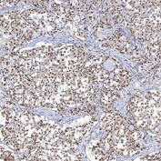 Immunohistochemistry analysis of TRMT61A / tRNA methyltransferase 61A antibody in human lung adenocarcinoma tissue. Formalin-fixed, paraffin-embedded human lung adenocarcinoma tissue was stained using TRMT61A / tRNA methyltransferase 61A antibody. Heat-induced epitope retrieval was performed by boiling tissue sections in EDTA buffer, pH 8.0, for 20 minutes, followed by cooling prior to antibody incubation. Brown chromogenic signal is observed predominantly in the nuclei and cytoplasm of tumor epithelial cells forming glandular structures, while surrounding stromal regions show comparatively reduced staining. This staining pattern reflects cellular expression of TRMT61A in lung adenocarcinoma tissue.
