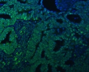 Immunofluorescent staining of FFPE human ovarian cancer tissue with TRMT61A/tRNA methyltransferase 61A antibody (green) and DAPI nuclear stain (blue). HIER: steam section in pH8 EDTA buffer for 20 min.