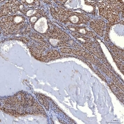 IHC staining of FFPE human breast cancer tissue with TRMT61A/tRNA methyltransferase 61A antibody. HIER: boil tissue sections in pH8 EDTA for 20 min and allow to cool before testing.