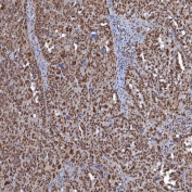 IHC staining of FFPE human ovarian serous cancer tissue with TRMT61A/tRNA methyltransferase 61A antibody. HIER: boil tissue sections in pH8 EDTA for 20 min and allow to cool before testing.