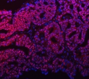 Immunofluorescent staining of FFPE human ovarian cancer tissue with mSin3A antibody (red) and DAPI (blue). HIER: steam section in pH8 EDTA buffer for 20 min.