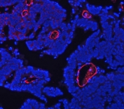 CD105 Antibody Ovarian Cancer Tissue IF. Immunofluorescence analysis of FFPE human ovarian cancer tissue using CD105 Antibody (red) demonstrates strong membranous staining of endothelial cells lining tumor-associated vasculature, consistent with Endoglin / CD105 expression as an endothelial marker of angiogenic blood vessels, while nuclei are counterstained with DAPI (blue). HIER: steam tissue sections in EDTA buffer, pH 8.0, for 20 min prior to immunostaining.