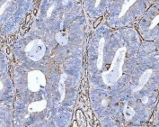 CD105 Antibody Endometrial Adenocarcinoma IHC. Immunohistochemistry analysis of FFPE human endometrial adenocarcinoma tissue using CD105 Antibody demonstrates HRP-DAB brown membranous staining of endothelial cells outlining tumor-associated vasculature within the stromal compartments, consistent with Endoglin / CD105 expression as an endothelial marker of angiogenic blood vessels, while tumor epithelial cells show minimal staining; nuclei are counterstained blue. HIER: boil tissue sections in pH 8 EDTA for 20 min and allow to cool before testing.