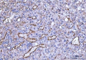 CD105 Antibody Liver Cancer IHC. Immunohistochemistry analysis of FFPE human liver cancer tissue using CD105 Antibody demonstrates HRP-DAB brown membranous staining of endothelial cells outlining irregular tumor-associated vasculature within the hepatic tumor parenchyma, consistent with Endoglin / CD105 expression as an endothelial marker of angiogenic blood vessels, while surrounding tumor cells show minimal staining; nuclei are counterstained blue. HIER: boil tissue sections in pH 8 EDTA for 20 min and allow to cool before testing.