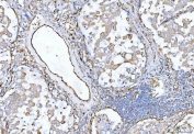 CD105 Antibody Lung Cancer IHC. Immunohistochemistry analysis of FFPE human lung cancer tissue using CD105 Antibody demonstrates HRP-DAB brown membranous staining of endothelial cells lining tumor-associated vasculature within stromal regions, consistent with Endoglin / CD105 expression as an endothelial marker of angiogenic blood vessels, while tumor epithelial cells show minimal staining; nuclei are counterstained blue. HIER: boil tissue sections in pH 8 EDTA for 20 min and allow to cool before testing.