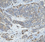 CD105 Antibody Bladder Urothelial Carcinoma IHC. Immunohistochemistry analysis of FFPE human bladder urothelial carcinoma tissue using CD105 Antibody demonstrates HRP-DAB brown membranous staining of endothelial cells outlining tumor-associated vasculature within stromal compartments, consistent with Endoglin / CD105 expression as an endothelial marker of angiogenic blood vessels, while surrounding tumor cells show minimal signal; nuclei are counterstained blue. HIER: boil tissue sections in pH 8 EDTA for 20 min and allow to cool before testing.