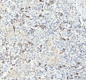 CHGA Antibody Testicular Germ Cell Tumor IHC. Immunohistochemistry staining of FFPE human testicular germ cell tumor tissue with CHGA antibody. HIER: boil tissue sections in pH8 EDTA for 20 min and allow to cool before testing.