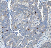 CHGA Antibody Colorectal Adenocarcinoma IHC. Immunohistochemistry staining of FFPE human colorectal adenocarcinoma tissue with CHGA antibody. HIER: boil tissue sections in pH8 EDTA for 20 min and allow to cool before testing.