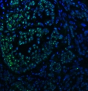 Immunofluorescent staining of FFPE human breast cancer tissue with SNRNP40 antibody (green) and DAPI nuclear stain (blue). HIER: steam section in pH8 EDTA buffer for 20 min.