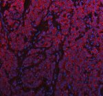 SNX9 Antibody Human Intestine Cancer IF. Immunofluorescent staining of FFPE human intestine cancer tissue with SNX9 Antibody at 5 ug/ml. HIER was performed using pH 8 EDTA buffer, followed by blocking with 10% goat serum. The tissue section was incubated with rabbit anti-SNX9 antibody overnight at 4Â°C, followed by Cy conjugated goat anti-rabbit IgG secondary antibody (red). Nuclei were counterstained with DAPI (blue). SNX9 Antibody, an endocytic trafficking protein marker, demonstrates cytoplasmic staining consistent with its role in vesicle transport, membrane remodeling and intracellular trafficking pathways.