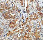 SNX9 Antibody Human Colon Cancer IHC. IHC staining of FFPE human colon cancer tissue with SNX9 Antibody at 2 ug/ml. HIER was performed using pH 8 EDTA buffer, followed by blocking with 10% goat serum. The tissue section was incubated with rabbit anti-SNX9 antibody overnight at 4Â°C, followed by HRP-conjugated goat anti-rabbit IgG secondary antibody and DAB chromogen detection. SNX9 Antibody, an endocytic trafficking protein marker, shows cytoplasmic staining in tumor cells consistent with its role in membrane remodeling, vesicle transport and intracellular trafficking regulation.