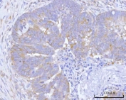 IHC staining of FFPE human rectum adenocarcinoma tissue with Hamartin antibody. HIER: boil tissue sections in pH8 EDTA for 20 min and allow to cool before testing.