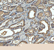 Immunohistochemical staining of FFPE human prostate cancer tissue with SGSH antibody, HRP-secondary and DAB substrate. HIER: boil tissue sections in pH8 EDTA for 20 min and allow to cool before testing.