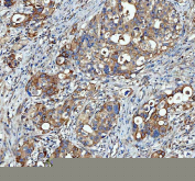 Immunohistochemical staining of FFPE human appendiceal adenocarcinoma tissue with SGSH antibody, HRP-secondary and DAB substrate. HIER: boil tissue sections in pH8 EDTA for 20 min and allow to cool before testing.