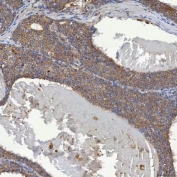 IHC staining of FFPE human breast cancer tissue with SHQ1 antibody. HIER: boil tissue sections in pH8 EDTA for 20 min and allow to cool before testing.