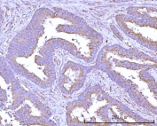 IHC staining of FFPE human colon adenocarcinoma tissue with RPS15A antibody. HIER: boil tissue sections in pH8 EDTA for 20 min and allow to cool before testing.