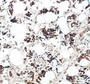Immunohistochemistry analysis of ROCK1 expression in human breast cancer tissue. Paraffin-embedded human breast cancer tissue sections were subjected to heat-mediated antigen retrieval in EDTA buffer (pH 8.0) and incubated with anti-ROCK1 antibody, followed by HRP-conjugated secondary antibody and DAB chromogen development. Brown staining is observed in tumor epithelial cells, consistent with cytoplasmic ROCK1 expression, with hematoxylin nuclear counterstain (blue).