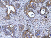 PDXDC1 Antibody Human Colorectal Cancer IHC. Immunohistochemistry staining of FFPE human colorectal adenocarcinoma tissue with PDXDC1 Antibody. HIER was performed using pH 8 EDTA buffer for 20 minutes prior to staining. The tissue section was incubated with PDXDC1 antibody, followed by HRP-conjugated secondary antibody and DAB chromogen detection. PDXDC1 Antibody / Pyridoxal Decarboxylase Domain Protein Antibody demonstrates cytoplasmic staining in colorectal cancer cells and supports studies of pyridoxal-dependent enzyme domain proteins, cellular metabolism and cancer biology pathways.