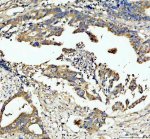 PDXDC1 Antibody Human Colon Cancer IHC. Immunohistochemistry staining of FFPE human colon cancer tissue with PDXDC1 Antibody at 2 ug/ml. HIER was performed using pH 8 EDTA buffer, followed by blocking with 10% goat serum. The tissue section was incubated with rabbit anti-PDXDC1 antibody overnight at 4Â°C, followed by HRP-conjugated goat anti-rabbit IgG secondary antibody and DAB chromogen detection. PDXDC1 Antibody / Pyridoxal Decarboxylase Domain Protein Antibody demonstrates cytoplasmic staining in colon cancer cells and supports studies of pyridoxal-dependent enzyme domain proteins, cellular metabolism and cancer biology pathways.