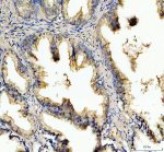 PDXDC1 Antibody Human Prostate Cancer IHC. Immunohistochemistry staining of FFPE human prostate cancer tissue with PDXDC1 Antibody at 2 ug/ml. HIER was performed using pH 8 EDTA buffer, followed by blocking with 10% goat serum. The tissue section was incubated with rabbit anti-PDXDC1 antibody overnight at 4Â°C, followed by HRP-conjugated goat anti-rabbit IgG secondary antibody and DAB chromogen detection. PDXDC1 Antibody / Pyridoxal Decarboxylase Domain Protein Antibody demonstrates cytoplasmic staining in prostate cancer cells and supports studies of pyridoxal-dependent enzyme domain proteins, cellular metabolism and cancer-associated cellular pathways.