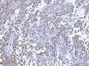 TMEM87A Antibody Human Lung Adenocarcinoma IHC. Immunohistochemical staining of FFPE human lung adenocarcinoma tissue using TMEM87A Antibody / Transmembrane Protein 87A Antibody. Heat-induced epitope retrieval was performed using pH8 EDTA buffer, followed by HRP-conjugated secondary antibody detection and DAB chromogen. Moderate cytoplasmic and membranous staining is observed in the tumor cells, consistent with the expected localization of TMEM87A. This TMEM87A Antibody, also called Transmembrane Protein 87A Antibody, is suitable for studies of membrane protein expression, intracellular trafficking, cellular signaling, and cancer biology.