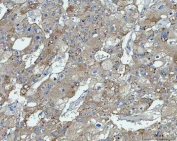 TMEM87A Antibody Human Liver Cancer IHC. Immunohistochemical staining of FFPE human liver cancer tissue using TMEM87A Antibody / Transmembrane Protein 87A Antibody. Heat-induced epitope retrieval was performed using pH8 EDTA buffer, followed by HRP-conjugated secondary antibody detection and DAB chromogen. Moderate diffuse cytoplasmic staining is observed throughout the tumor cells, with occasional membranous accentuation, consistent with the expected localization of TMEM87A. This TMEM87A Antibody, also called Transmembrane Protein 87A Antibody, is suitable for studies of membrane protein expression, intracellular trafficking, cellular signaling, and cancer biology.