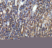 IHC staining of FFPE human thyroid cancer tissue with PGAM1 antibody, HRP-secondary and DAB substrate. HIER: boil tissue sections in pH8 EDTA for 20 min and allow to cool before testing.