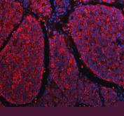Immunofluorescent staining of FFPE human liver cancer tissue with PCCB antibody (red) and DAPI nuclear stain (blue). HIER: steam section in pH8 EDTA buffer for 20 min.