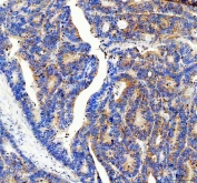 IHC staining of FFPE human colon cancer tissue with 40S ribosomal protein S14 antibody. HIER: boil tissue sections in pH8 EDTA for 20 min and allow to cool before testing.